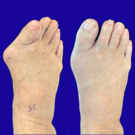 bunion surgery near me